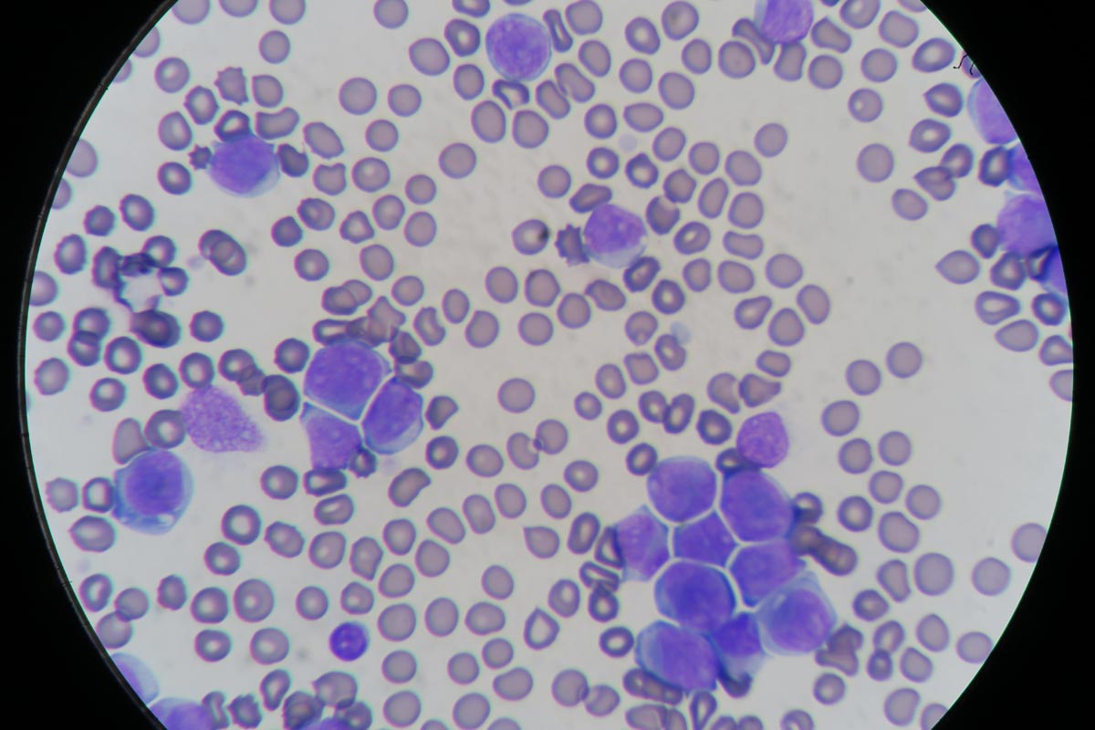 Blood smears – make them a routine test